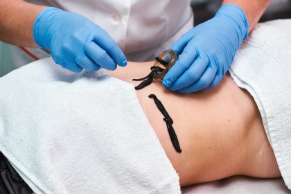 Во время реабилитации после перенесенного коронавируса поможет гирудотерапия